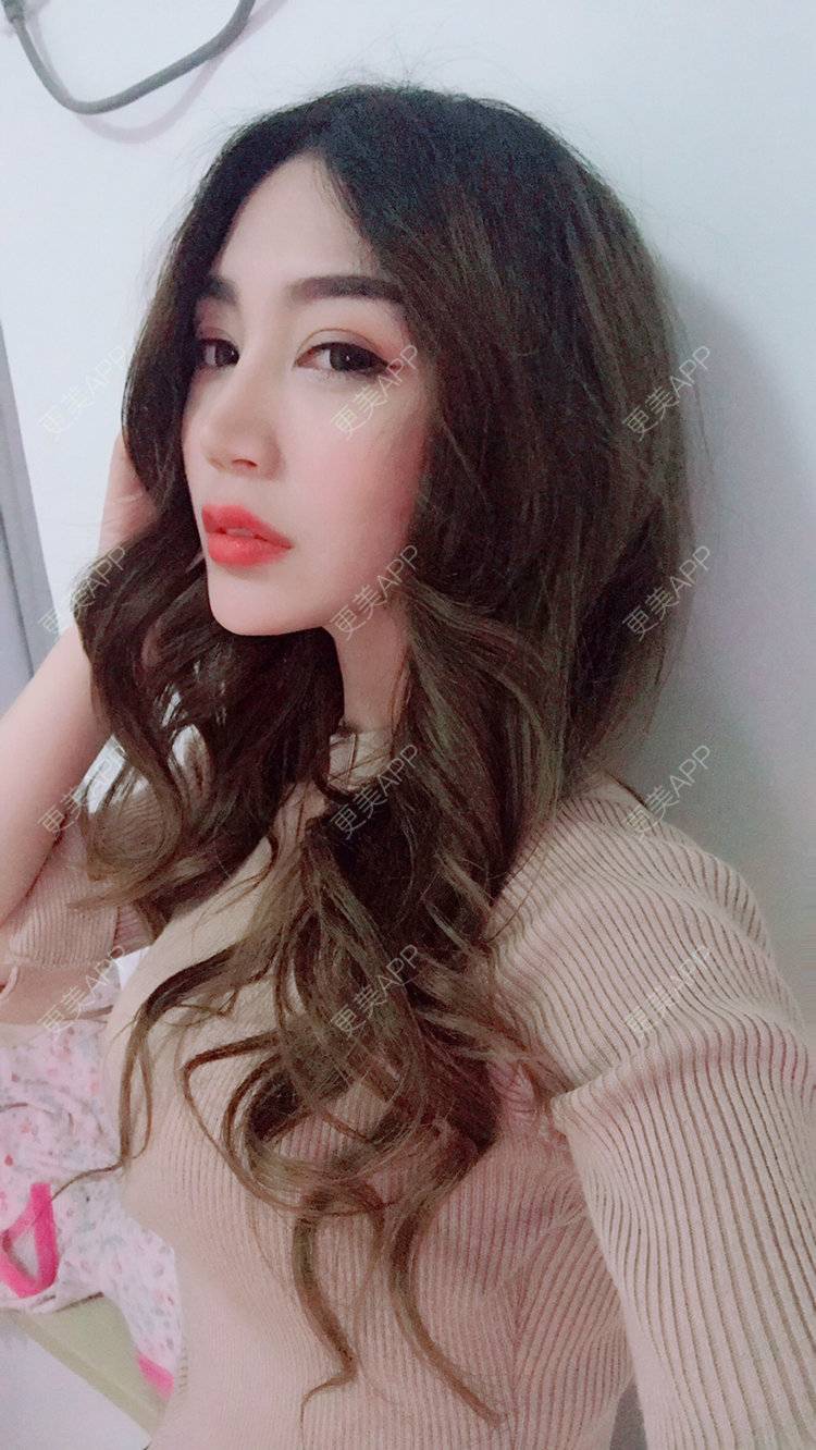 更美 - Bobbyya🌊的肋软骨隆鼻经验 | 肋软骨隆鼻 | 武汉