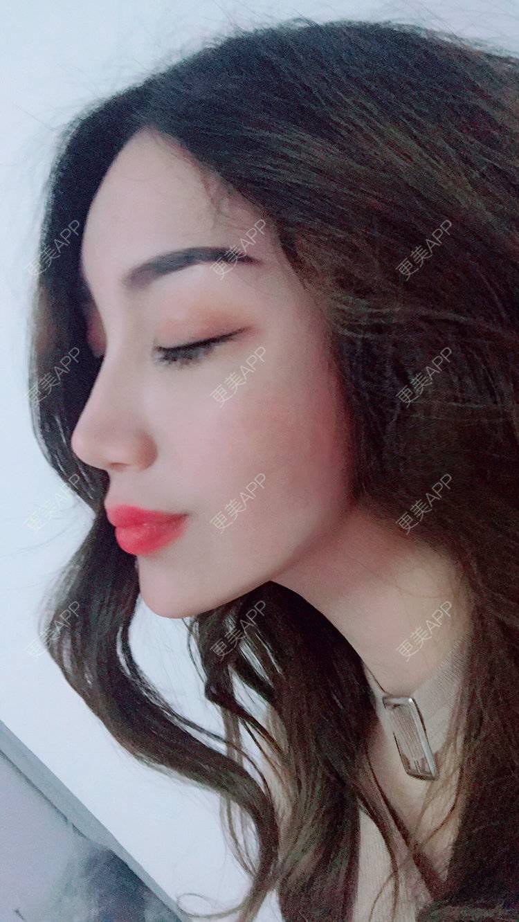 更美 - Bobbyya🌊的肋软骨隆鼻经验 | 肋软骨隆鼻 | 武汉