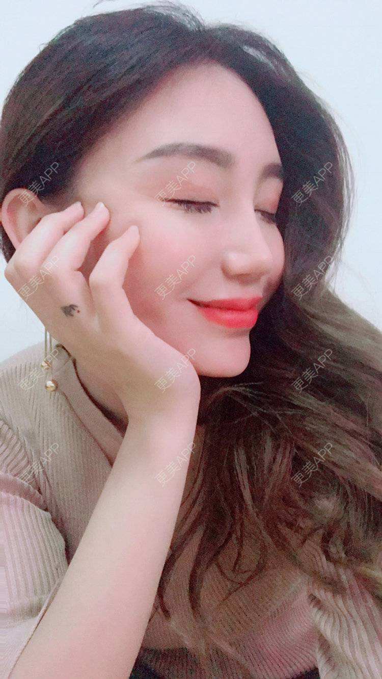 更美 - Bobbyya🌊的肋软骨隆鼻经验 | 肋软骨隆鼻 | 武汉