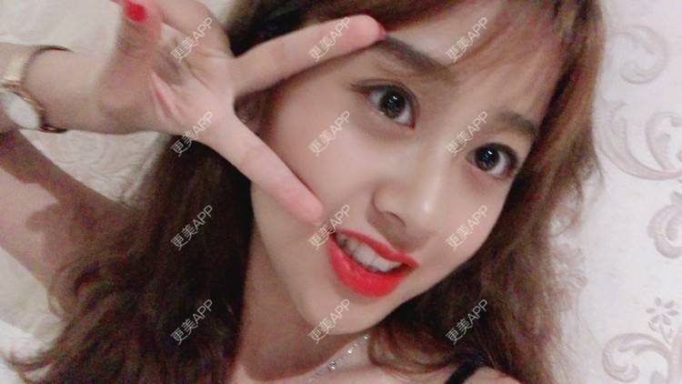 更美 - 更美用户KC03iU3j1t的玻尿酸苹果肌经验 | 玻尿酸苹果肌