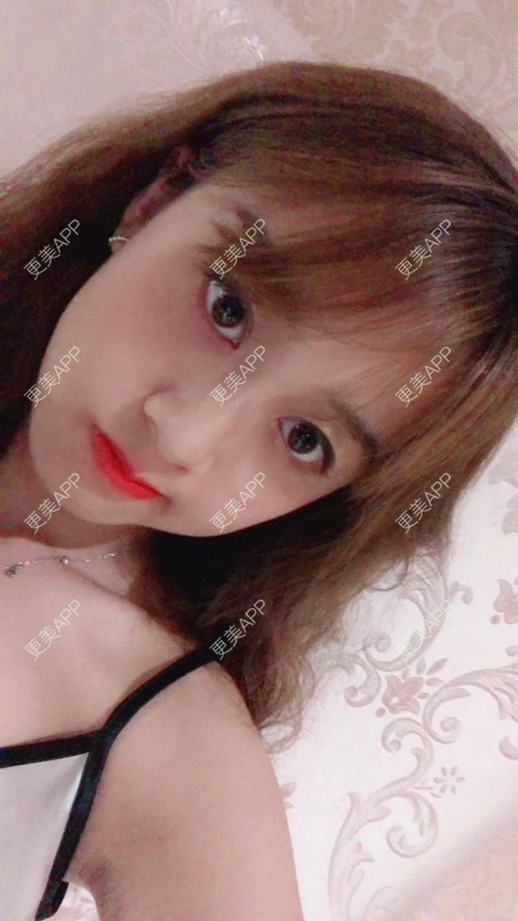 更美 - 更美用户KC03iU3j1t的玻尿酸苹果肌经验 | 玻尿酸苹果肌