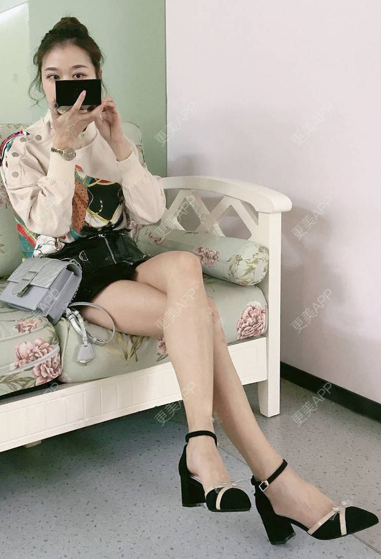 更美 - 更美用户GW64OOXNN4的吸脂瘦大腿经验 | 佛山 | 吸脂瘦大腿
