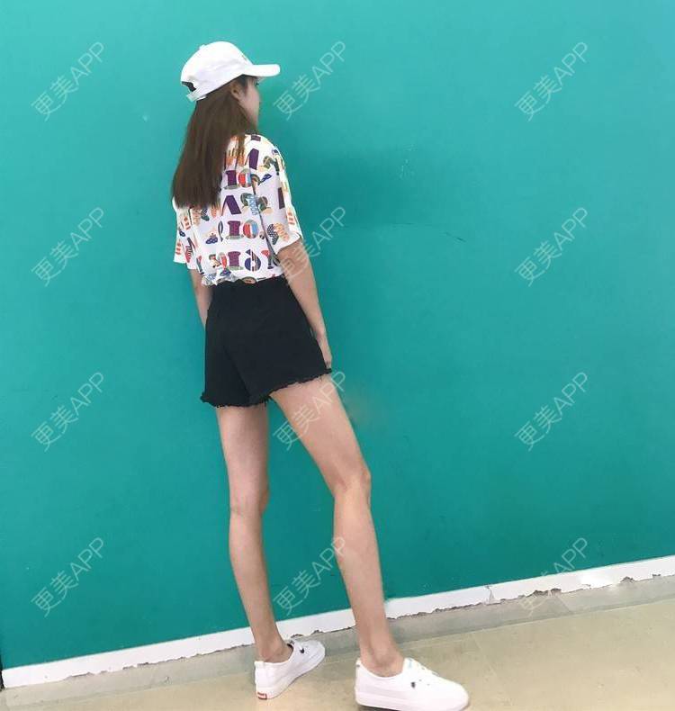 更美 - 更美用户GW64OOXNN4的吸脂瘦大腿经验 | 佛山 | 吸脂瘦大腿