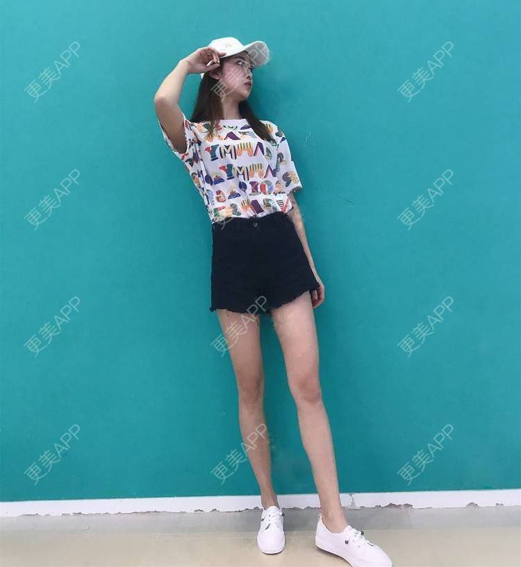更美 - 更美用户GW64OOXNN4的吸脂瘦大腿经验 | 佛山 | 吸脂瘦大腿