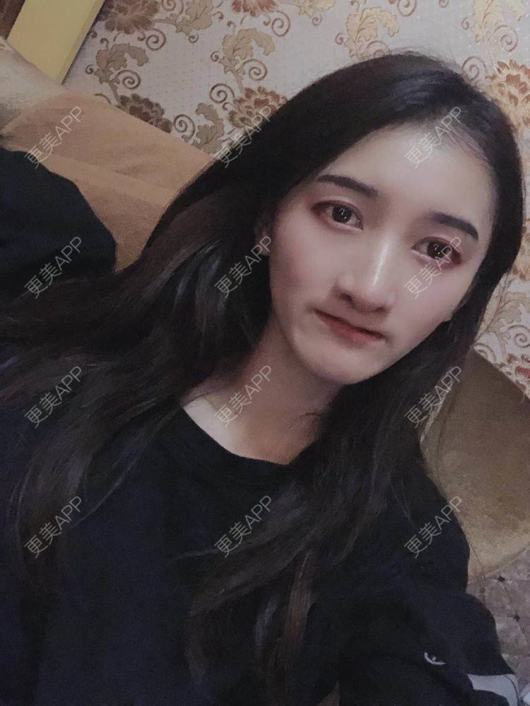 更美 - 最美的期待i的鼻形态修复经验 | 广州 | 鼻形态修复