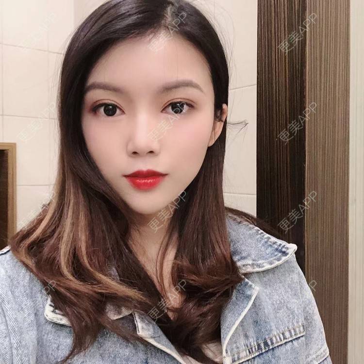 更美 - 更美用户T3PhxaY9Vo的玻尿酸下巴经验 | 广州 | 视频日记 | 玻尿酸下巴