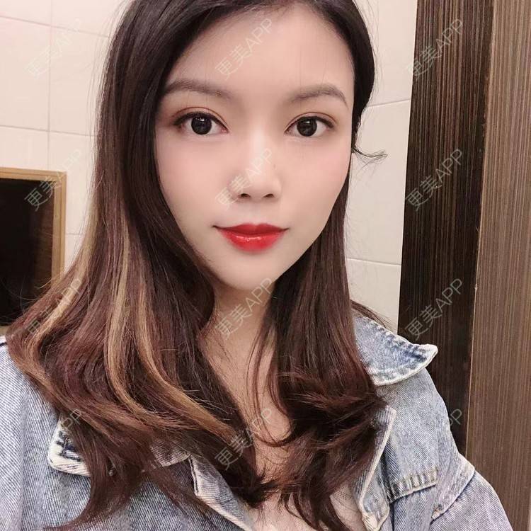 更美 - 更美用户T3PhxaY9Vo的玻尿酸下巴经验 | 广州 | 视频日记 | 玻尿酸下巴