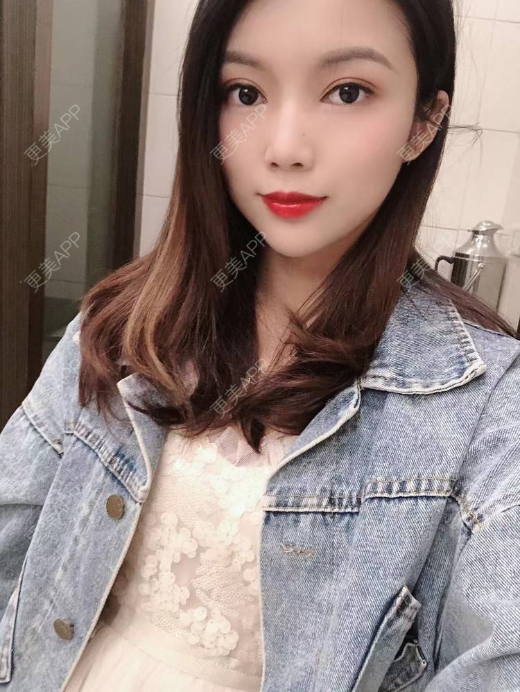 更美 - 更美用户T3PhxaY9Vo的玻尿酸下巴经验 | 广州 | 视频日记 | 玻尿酸下巴