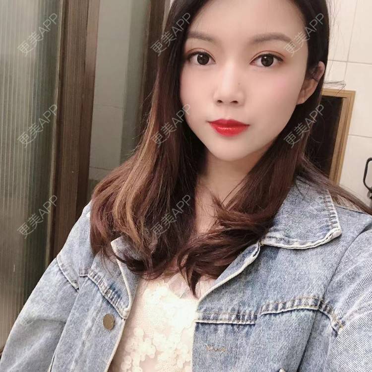 更美 - 更美用户T3PhxaY9Vo的玻尿酸下巴经验 | 广州 | 视频日记 | 玻尿酸下巴