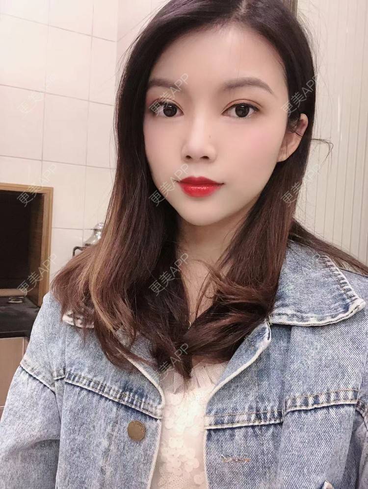 更美 - 更美用户T3PhxaY9Vo的玻尿酸下巴经验 | 广州 | 视频日记 | 玻尿酸下巴