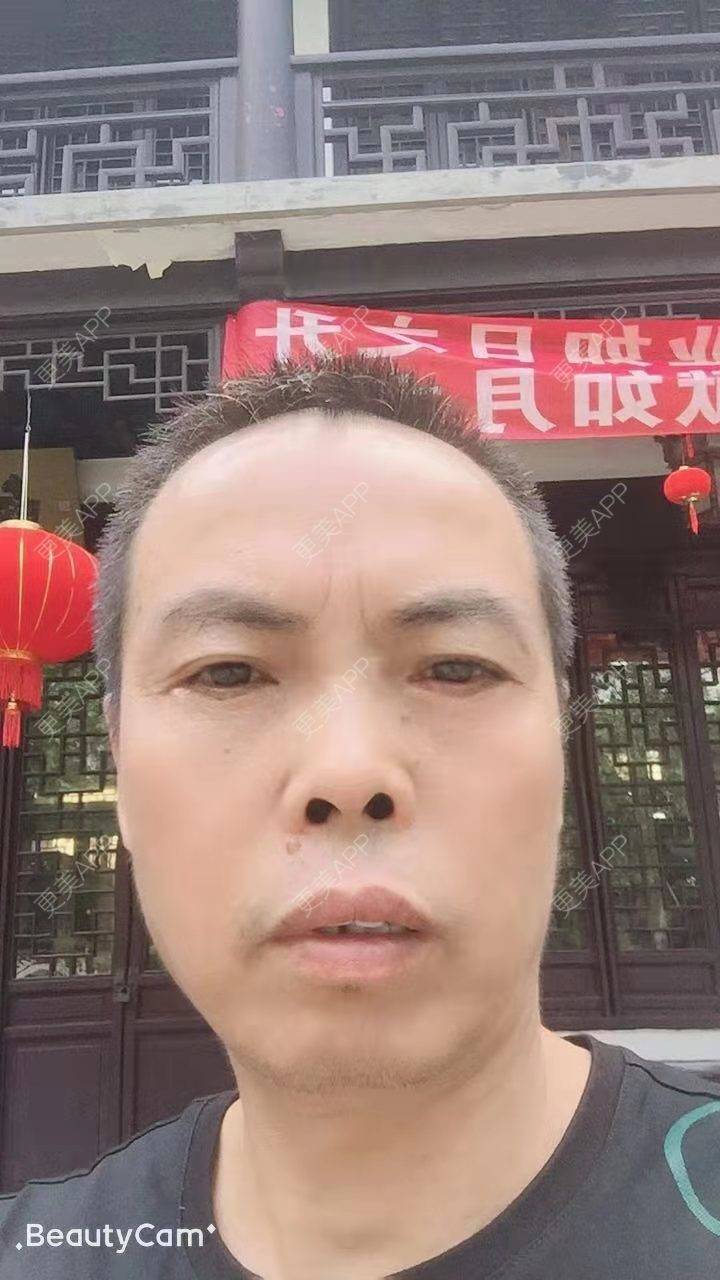 更美 - 更美用户IG0lQLfUjW的外切去眼袋经验 | 杭州 | 外切去眼袋