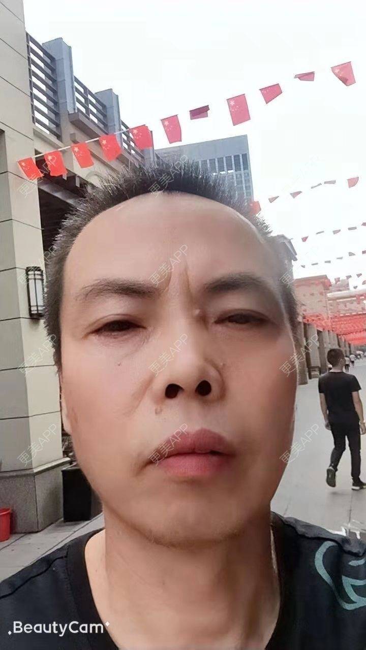 更美 - 更美用户IG0lQLfUjW的外切去眼袋经验 | 杭州 | 外切去眼袋