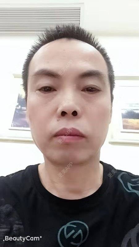 更美 - 更美用户IG0lQLfUjW的外切去眼袋经验 | 杭州 | 外切去眼袋