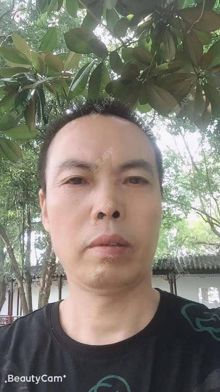 更美 - 更美用户IG0lQLfUjW的外切去眼袋经验 | 杭州 | 外切去眼袋