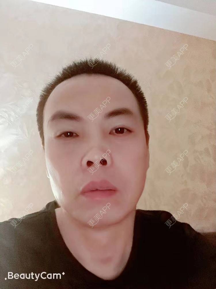 更美 - 更美用户IG0lQLfUjW的外切去眼袋经验 | 杭州 | 外切去眼袋