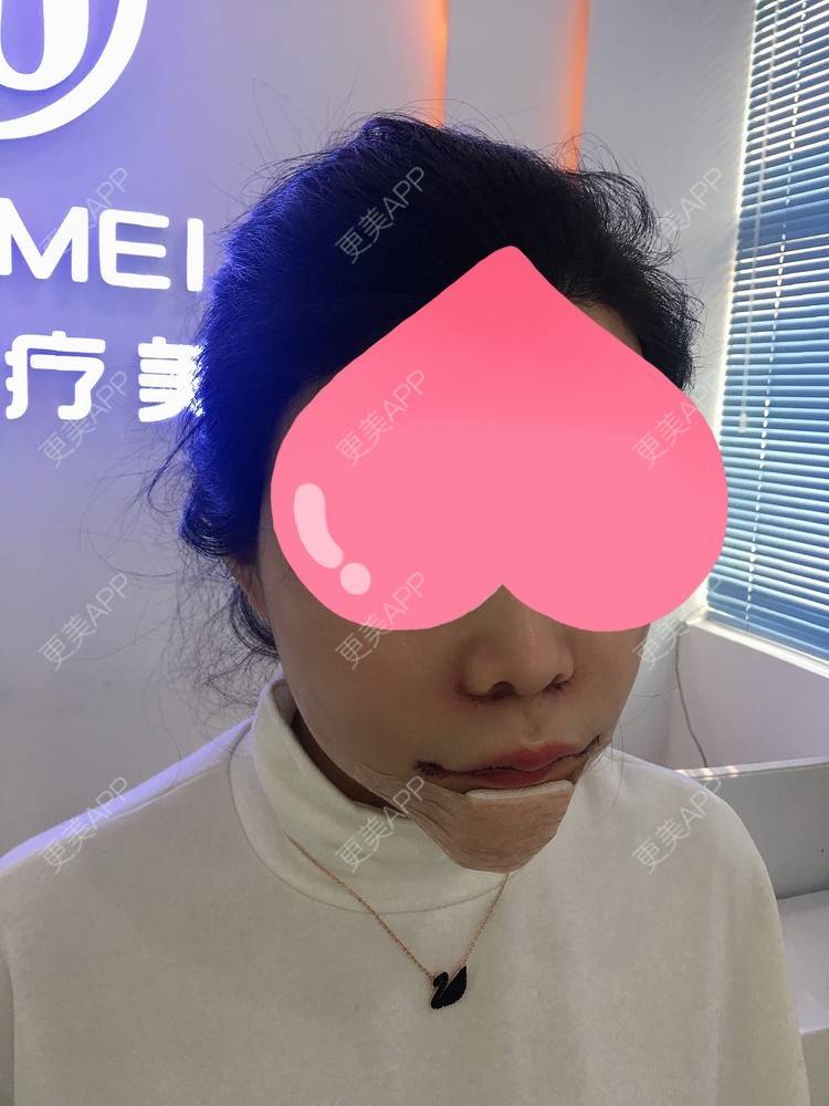 更美用户tflc1br17u的埋线提升紧致日记