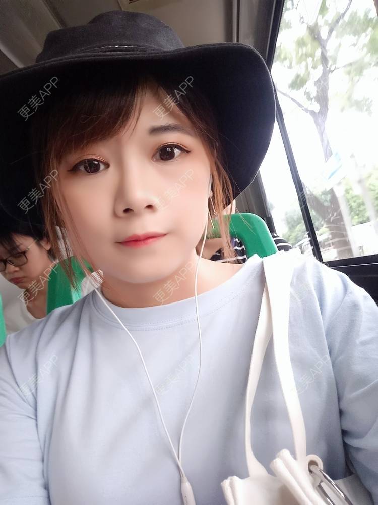 更美 - 更美用户2xAqCgwVY0的内切去眼袋经验 | 内切去眼袋 | 武汉