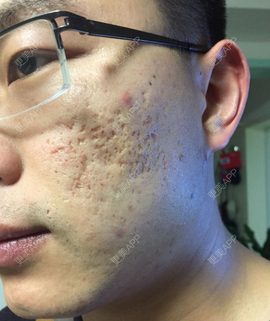 点阵激光清痘/痘坑/痘印/痤疮 收缩毛孔 改善疤痕色沉【新客专享】