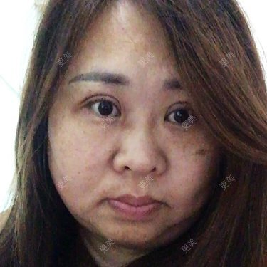 鼻翼缩小