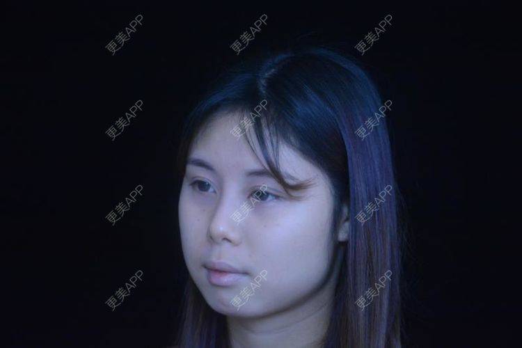 更美 - 瘋子范ル内的除皱瘦脸经验 | 玻尿酸面部细纹 | 除皱瘦脸 | 玻尿酸苹果肌 | 南宁