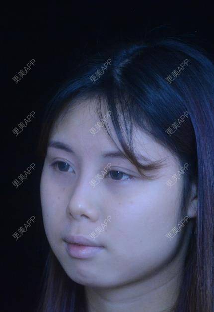 更美 - 瘋子范ル内的除皱瘦脸经验 | 玻尿酸面部细纹 | 除皱瘦脸 | 玻尿酸苹果肌 | 南宁