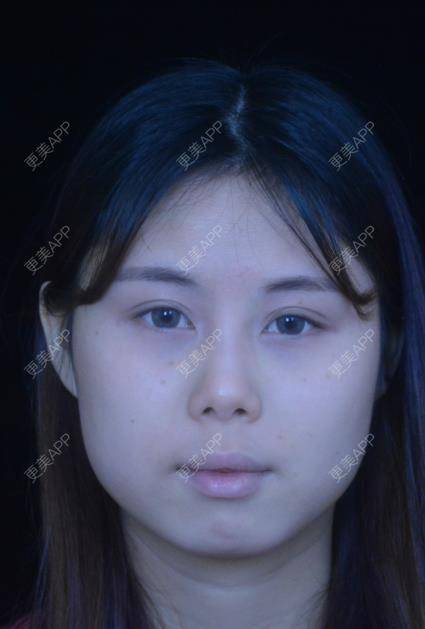 更美 - 瘋子范ル内的除皱瘦脸经验 | 玻尿酸面部细纹 | 除皱瘦脸 | 玻尿酸苹果肌 | 南宁