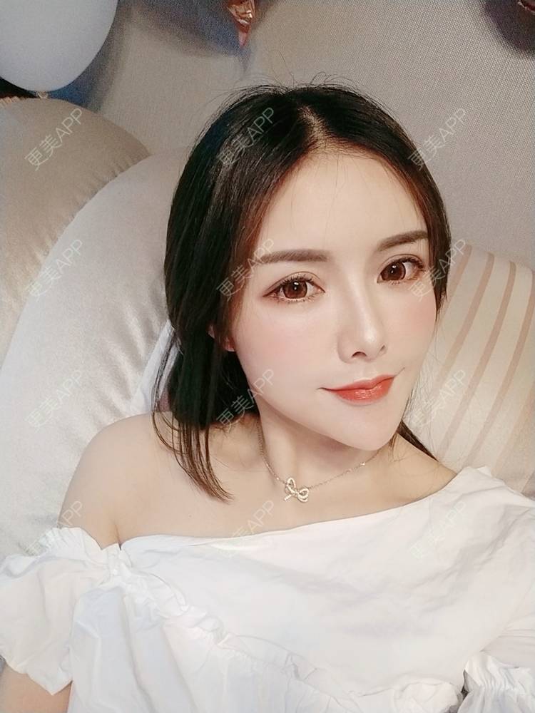 更美 - Daisy11的自体脂肪全面部填充经验 | 自体脂肪全面部填充 | 视频日记 | 重庆