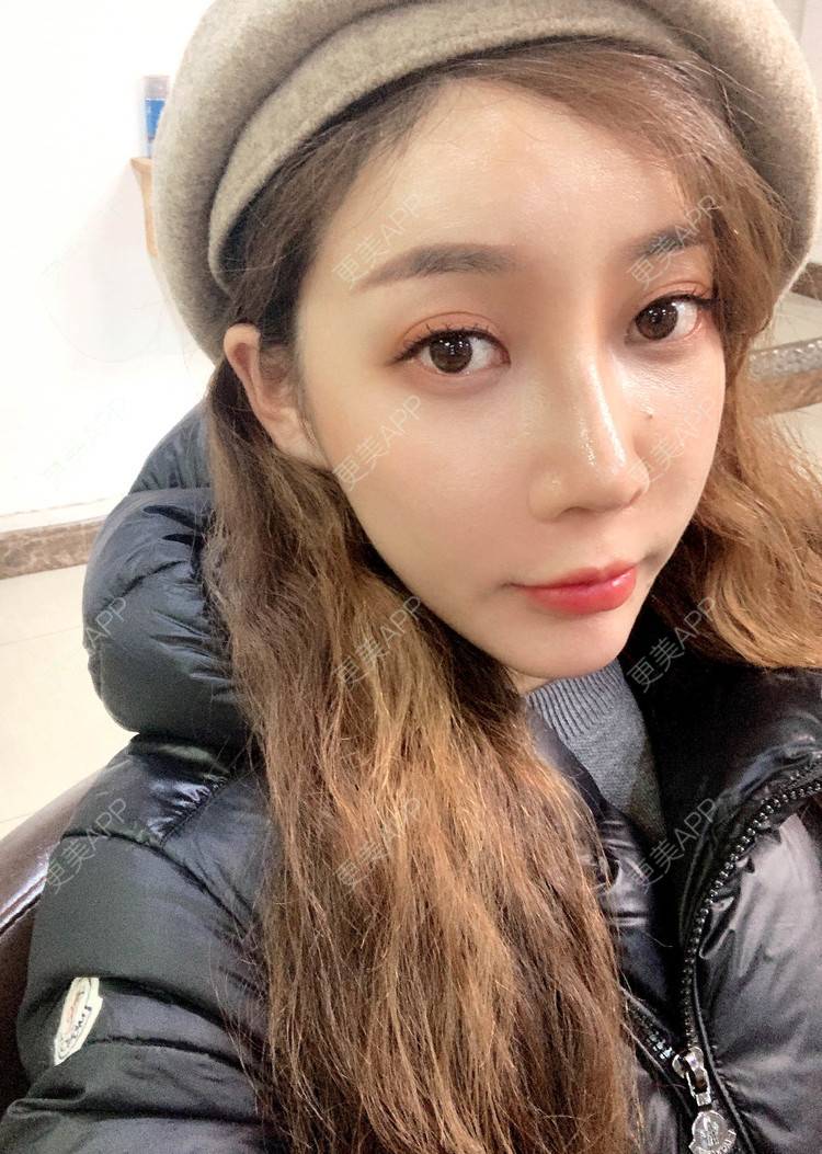 更美用户exblGQ6y2s的假体垫鼻基底