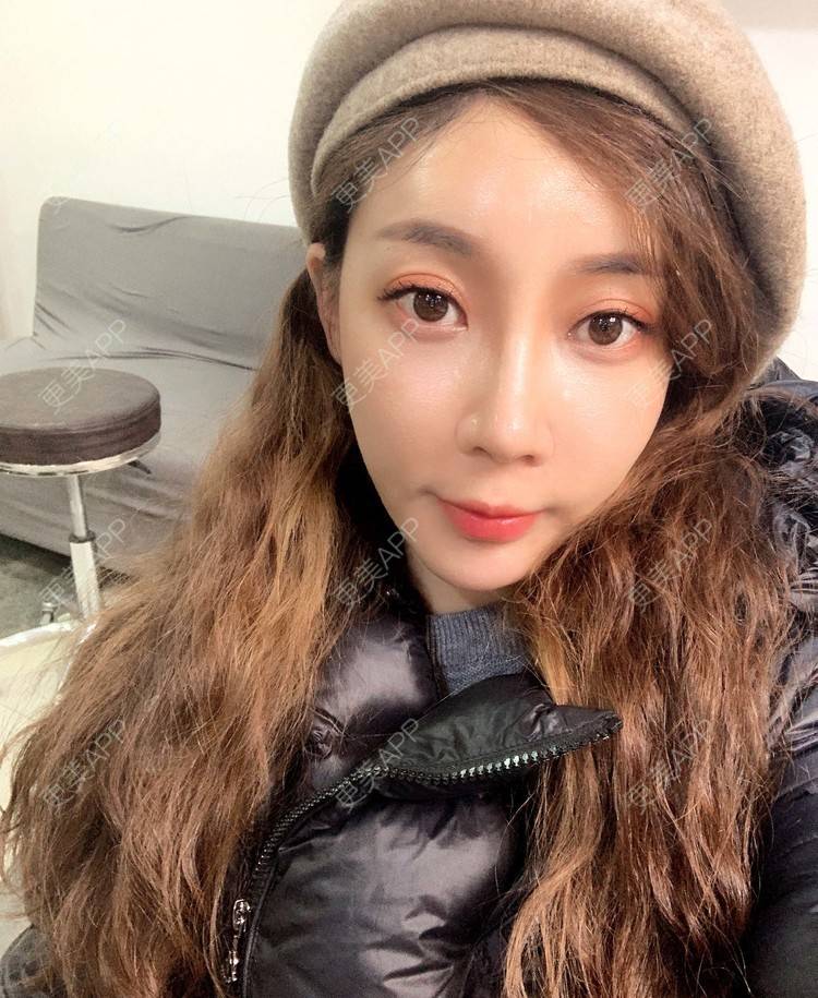 更美用户exblGQ6y2s的假体垫鼻基底