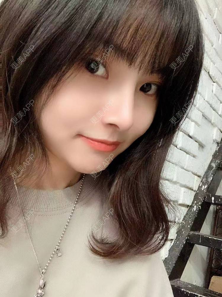 更美 - 大美人图的自体脂肪丰额头经验 | 更美研究所 | 杭州 | 自体脂肪丰额头