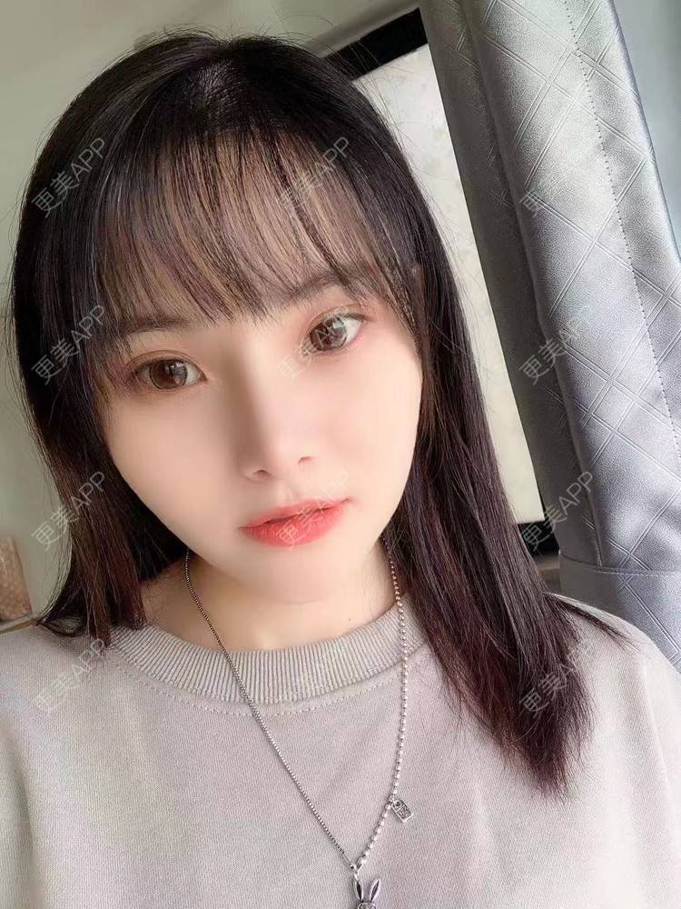 更美 - 大美人图的自体脂肪丰额头经验 | 更美研究所 | 杭州 | 自体脂肪丰额头