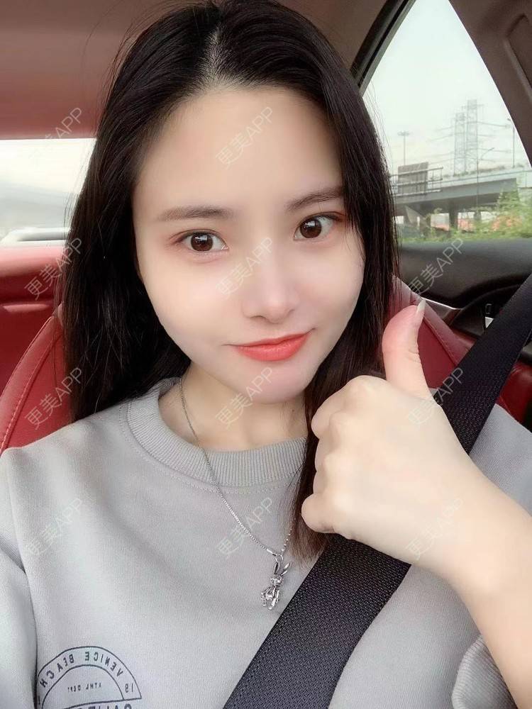 更美 - 大美人图的自体脂肪丰额头经验 | 更美研究所 | 杭州 | 自体脂肪丰额头