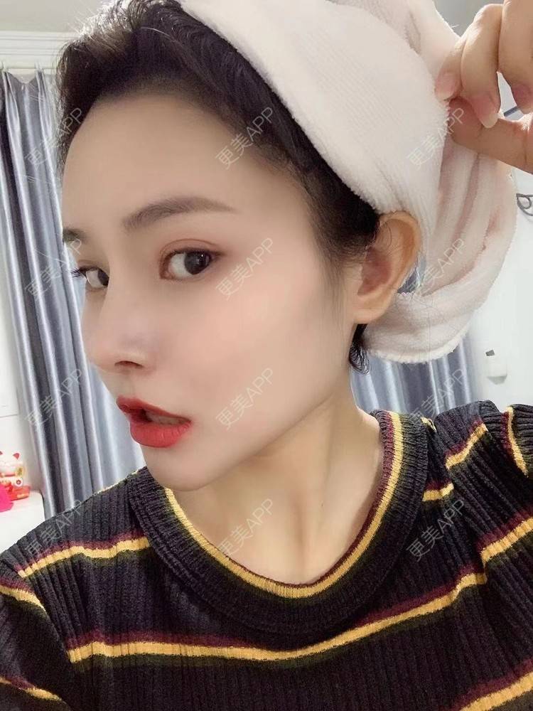 更美 - 大美人图的自体脂肪丰额头经验 | 更美研究所 | 杭州 | 自体脂肪丰额头