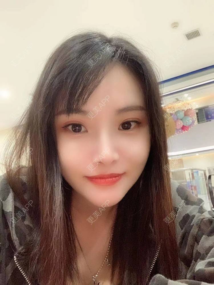 更美 - 大美人图的自体脂肪丰额头经验 | 更美研究所 | 杭州 | 自体脂肪丰额头