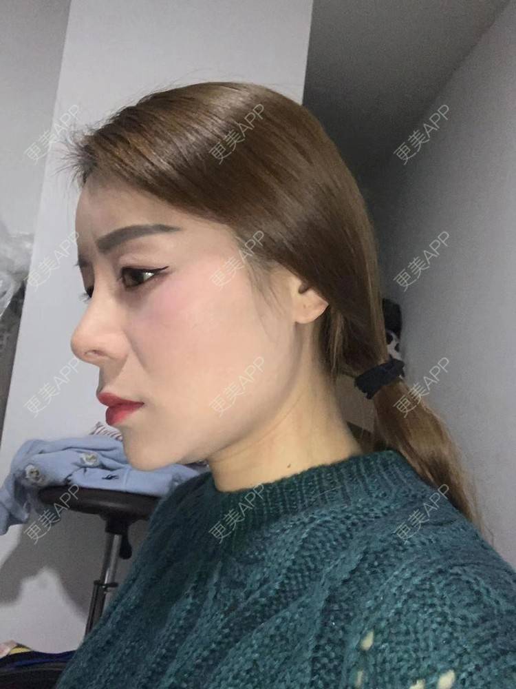 更美 - ehkc的肋软骨隆鼻经验 | 更美研究所 | 杭州 | 肋软骨隆鼻 | 隆鼻