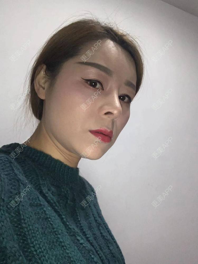 更美 - ehkc的肋软骨隆鼻经验 | 更美研究所 | 杭州 | 肋软骨隆鼻 | 隆鼻