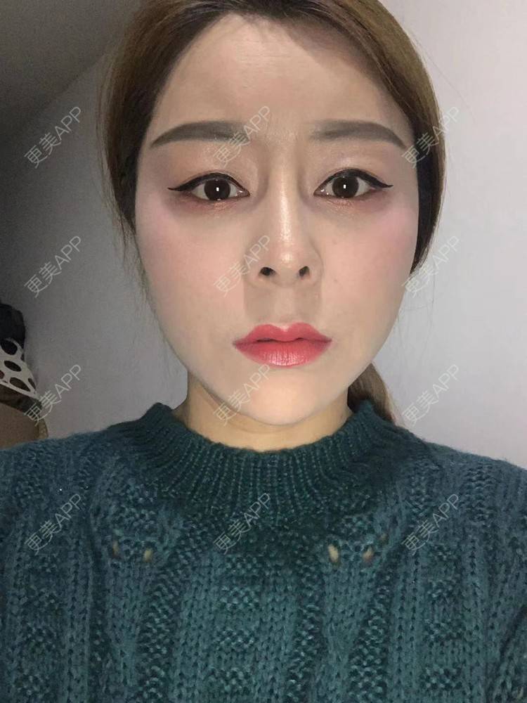 更美 - ehkc的肋软骨隆鼻经验 | 更美研究所 | 杭州 | 肋软骨隆鼻 | 隆鼻