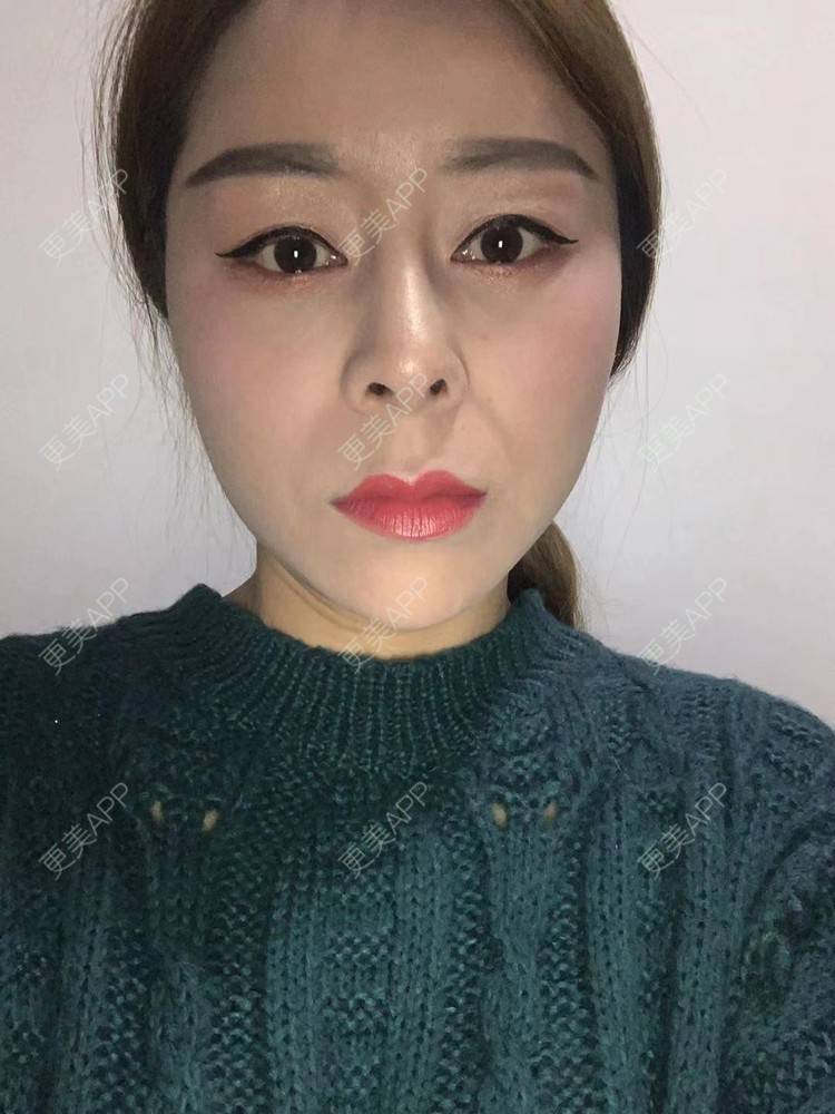 更美 - ehkc的肋软骨隆鼻经验 | 更美研究所 | 杭州 | 肋软骨隆鼻 | 隆鼻