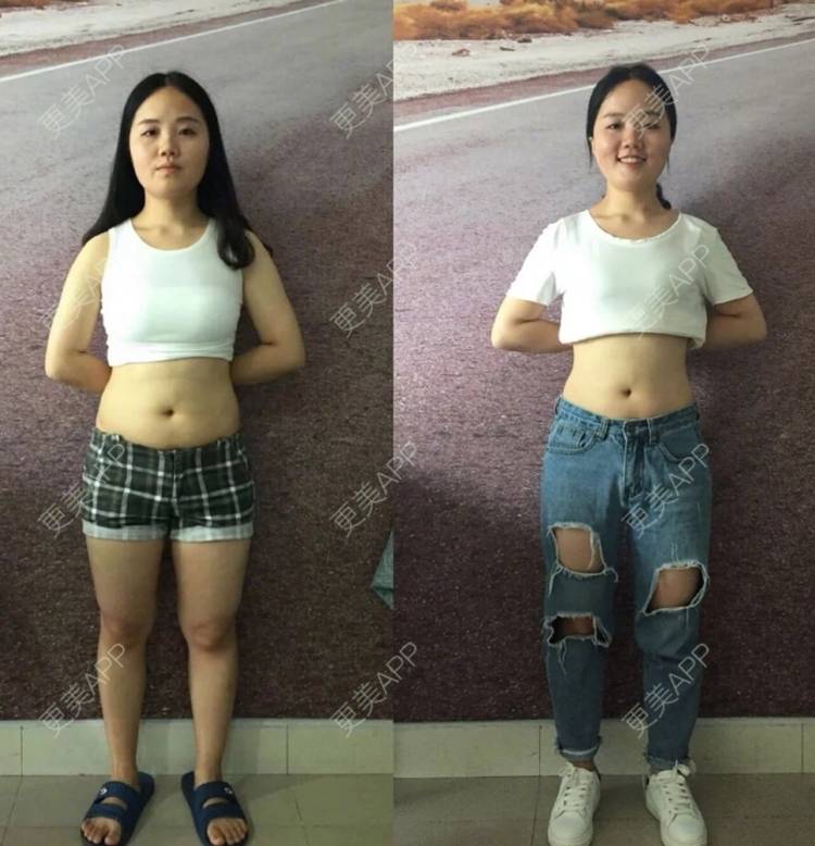更美 - 这年头、想死都难扒及的超声溶脂经验 | 深圳 | 超声溶脂