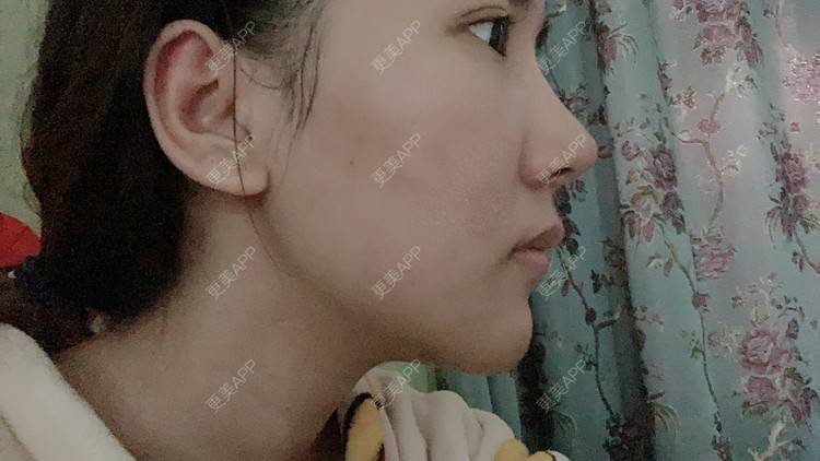 更美 - 林林兮兮的硅胶垫下巴经验 | 硅胶垫下巴 | 武汉
