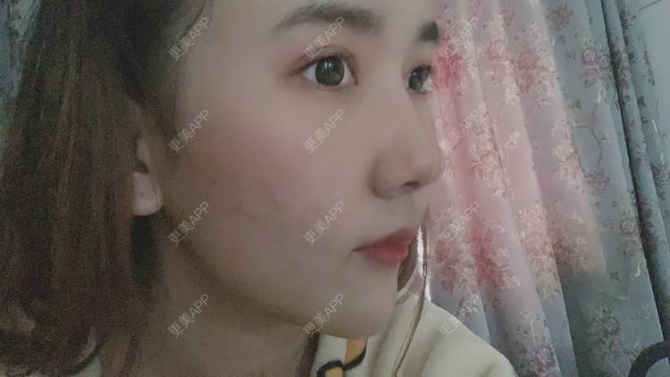 更美 - 林林兮兮的硅胶垫下巴经验 | 硅胶垫下巴 | 武汉