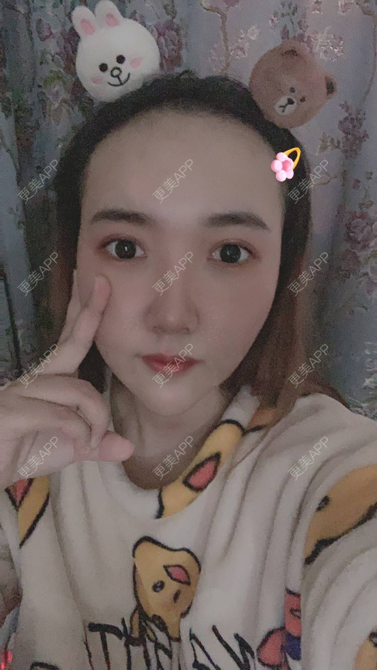 更美 - 林林兮兮的硅胶垫下巴经验 | 硅胶垫下巴 | 武汉