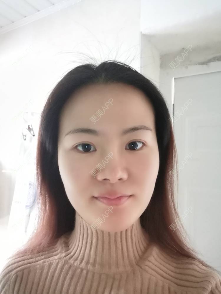 更美 - umgsd的植发际线经验 | 植发际线 | 上海