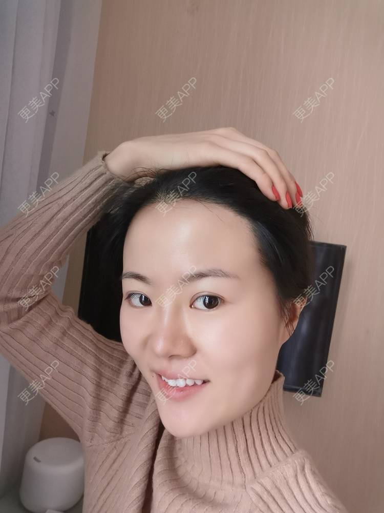 更美 - umgsd的植发际线经验 | 植发际线 | 上海