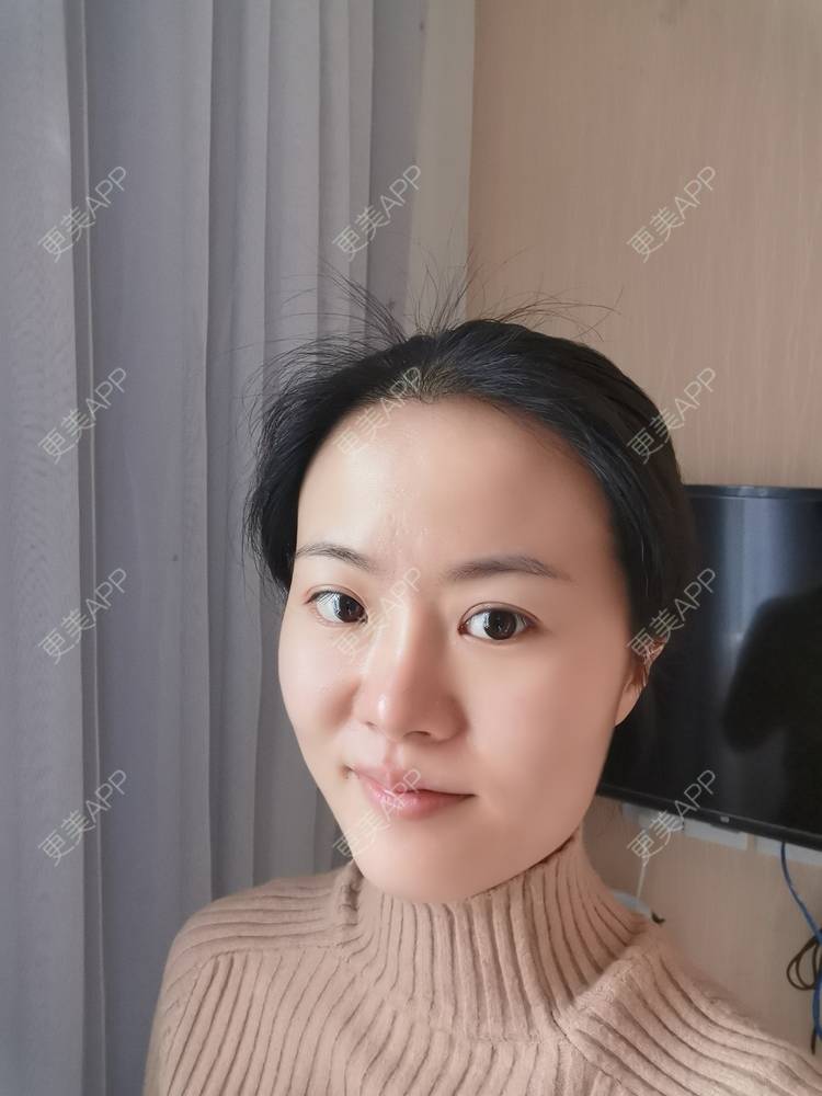 更美 - umgsd的植发际线经验 | 植发际线 | 上海