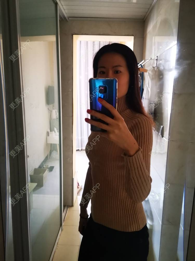 更美 - umgsd的植发际线经验 | 植发际线 | 上海