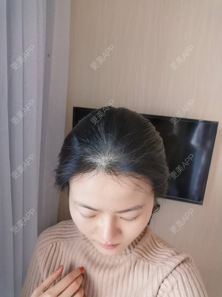 更美 - umgsd的植发际线经验 | 植发际线 | 上海