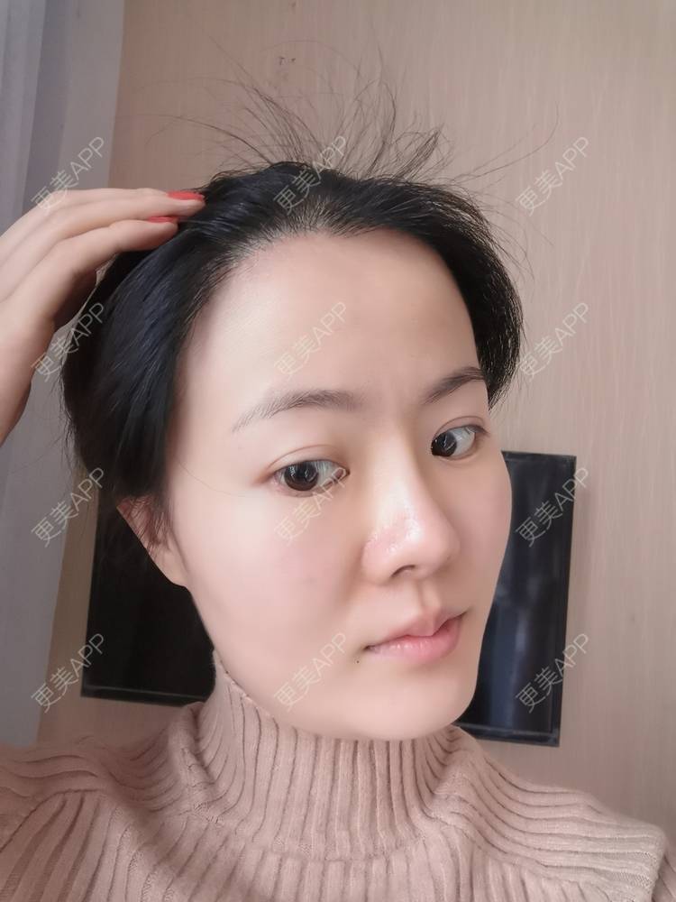 更美 - umgsd的植发际线经验 | 植发际线 | 上海