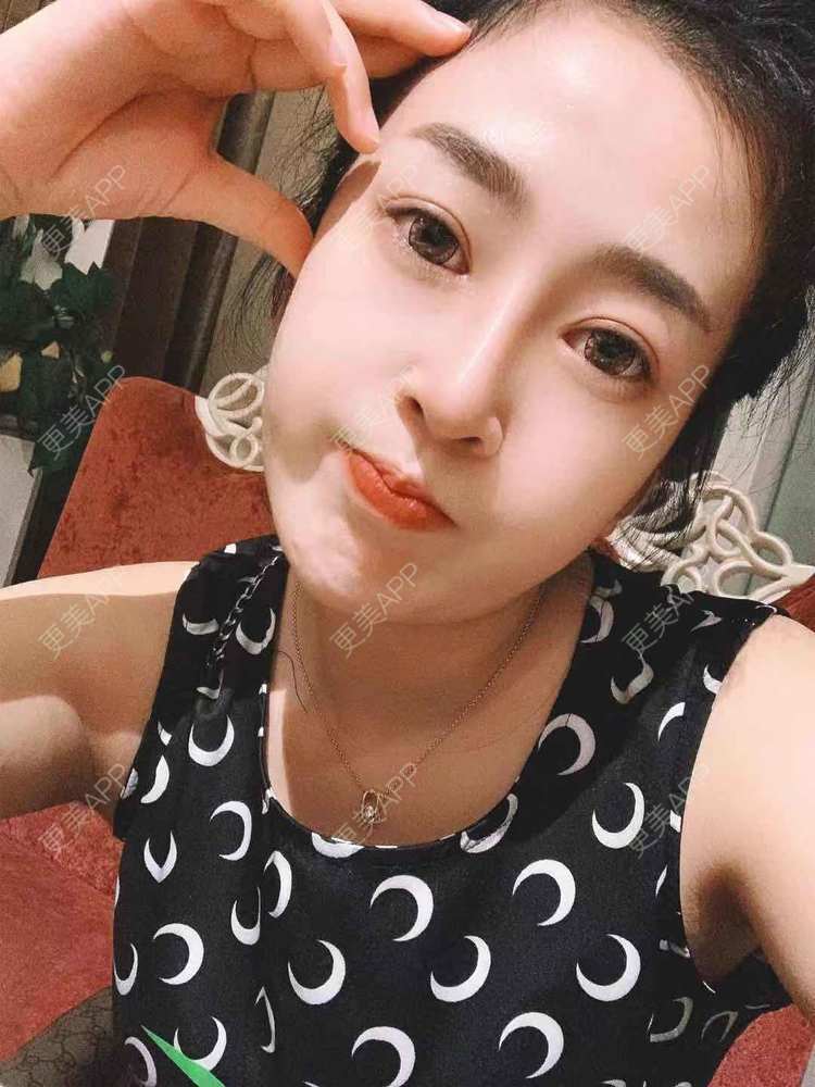 更美 - 更美用户eQZyR2BAtN的膨体隆鼻经验 | 肋软骨隆鼻 | 膨体隆鼻 | 埋线隆鼻 | 耳软骨隆鼻 | 鼻翼缩小