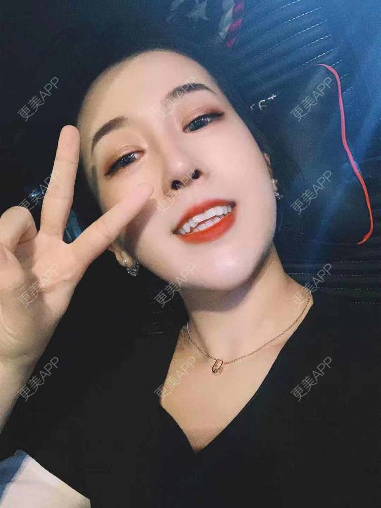 更美 - 更美用户eQZyR2BAtN的膨体隆鼻经验 | 肋软骨隆鼻 | 膨体隆鼻 | 埋线隆鼻 | 耳软骨隆鼻 | 鼻翼缩小